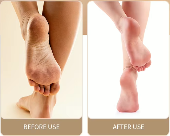 LoSilk Callus Remover